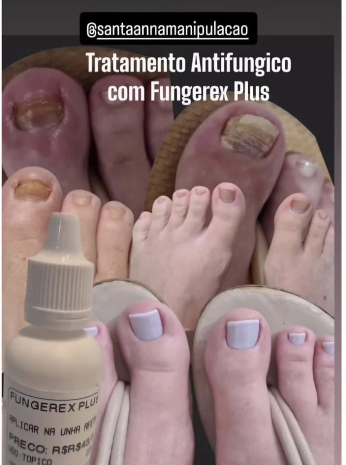 unhas tratadas com Fungerex plus